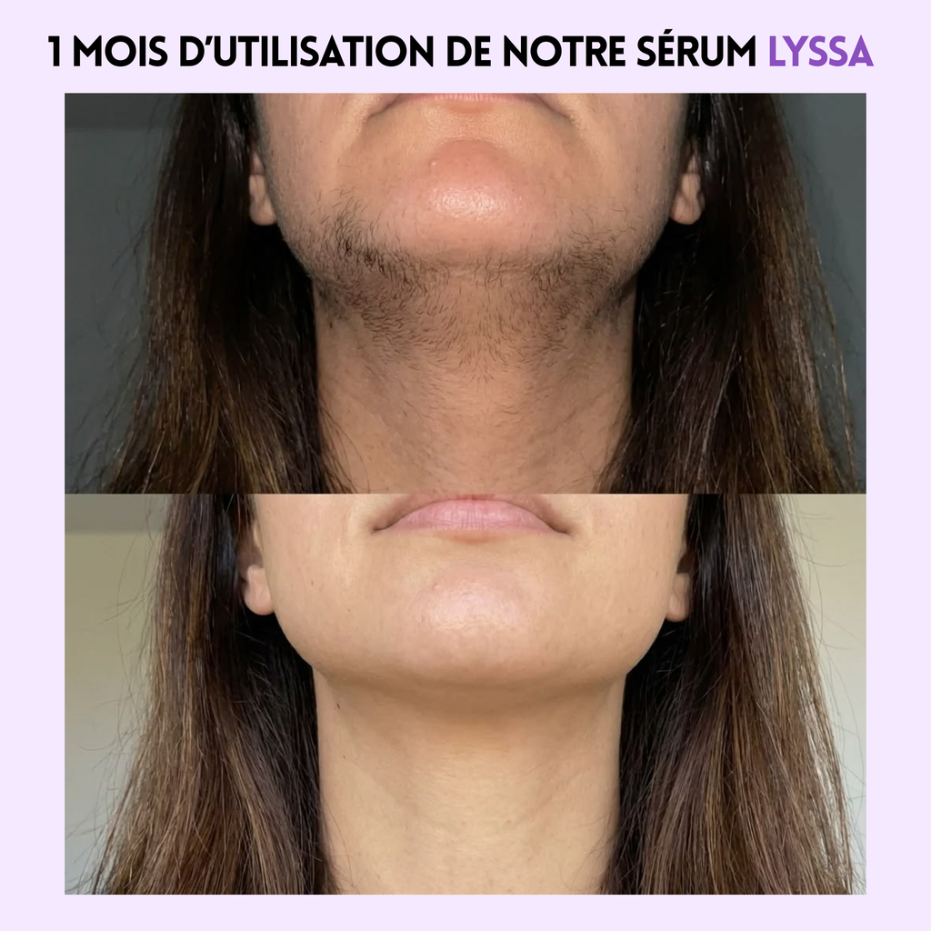 Huile anti repousse poils Lyssa™